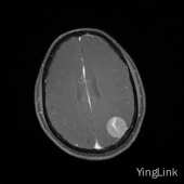 【病例】左顶部脑膜瘤1例MR影像表现 【病例】左顶部脑膜瘤1例MR影像表现