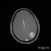 【病例】左顶部脑膜瘤1例MR影像表现 【病例】左顶部脑膜瘤1例MR影像表现