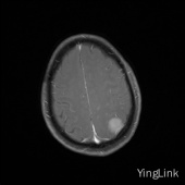 【病例】左顶部脑膜瘤1例MR影像表现 【病例】左顶部脑膜瘤1例MR影像表现