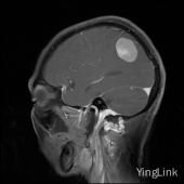 【病例】左顶部脑膜瘤1例MR影像表现 【病例】左顶部脑膜瘤1例MR影像表现