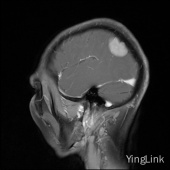 【病例】左顶部脑膜瘤1例MR影像表现 【病例】左顶部脑膜瘤1例MR影像表现