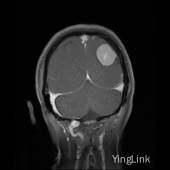 【病例】左顶部脑膜瘤1例MR影像表现 【病例】左顶部脑膜瘤1例MR影像表现
