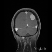 【病例】左顶部脑膜瘤1例MR影像表现 【病例】左顶部脑膜瘤1例MR影像表现