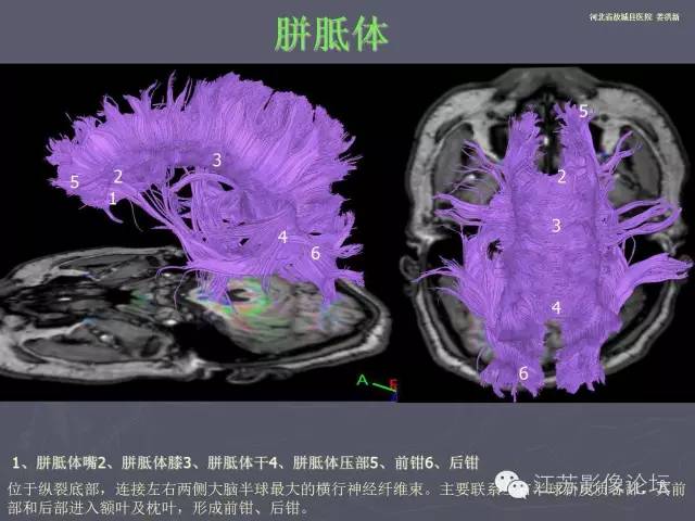 【PPT】磁共振DTI成像—联络纤维