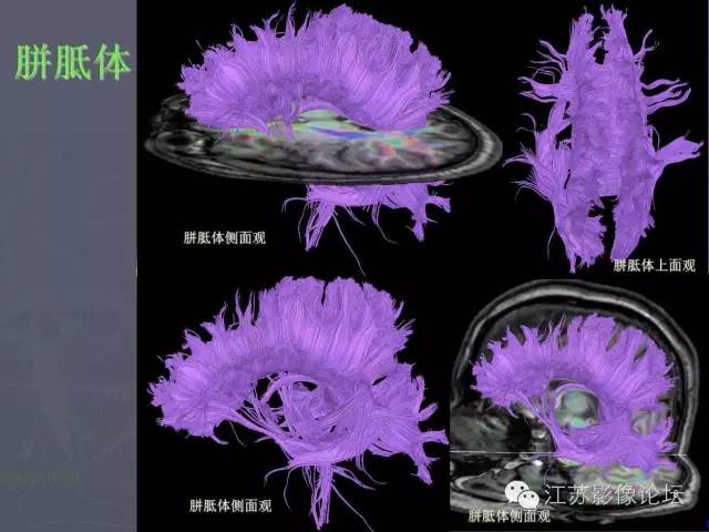 【PPT】磁共振DTI成像—联络纤维