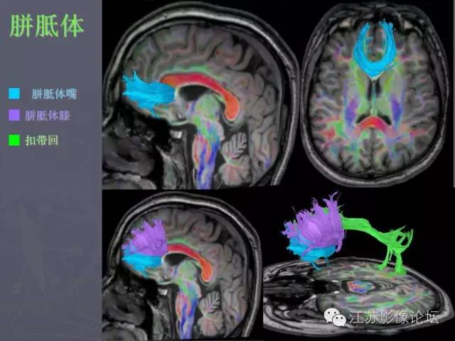【PPT】磁共振DTI成像—联络纤维