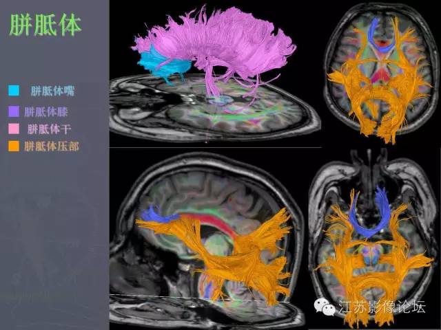 【PPT】磁共振DTI成像—联络纤维