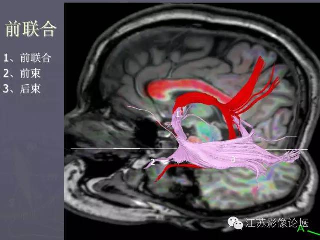 【PPT】磁共振DTI成像—联络纤维