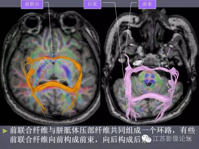 【PPT】磁共振DTI成像—联络纤维