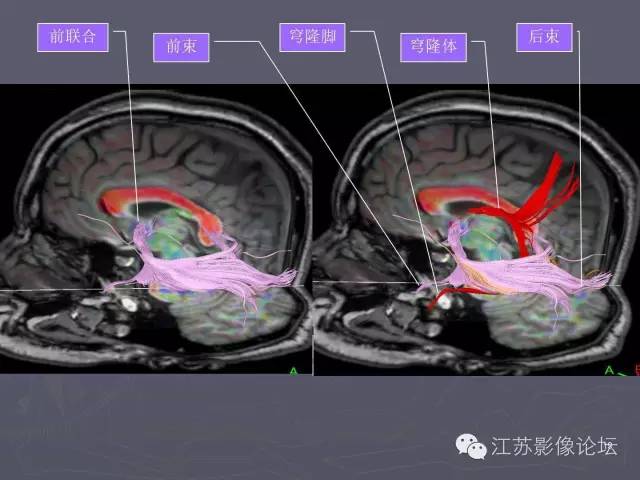 【PPT】磁共振DTI成像—联络纤维