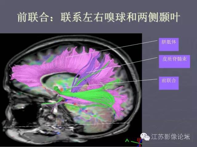 【PPT】磁共振DTI成像—联络纤维