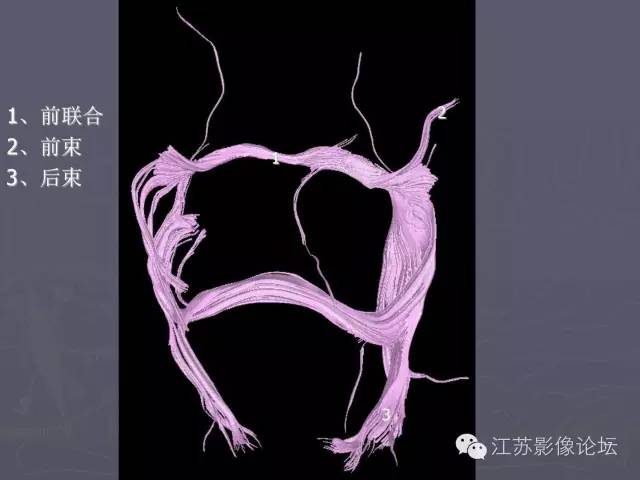 【PPT】磁共振DTI成像—联络纤维
