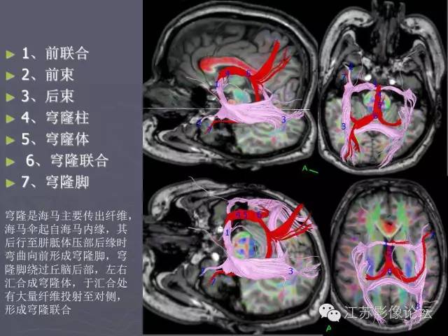 【PPT】磁共振DTI成像—联络纤维