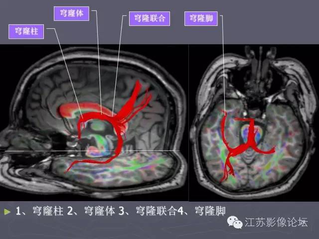 【PPT】磁共振DTI成像—联络纤维