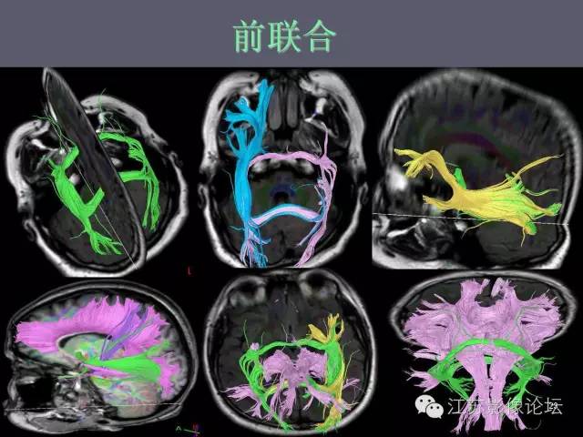 【PPT】磁共振DTI成像—联络纤维