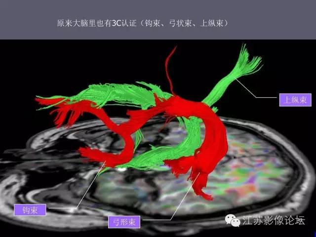 【PPT】磁共振DTI成像—联络纤维