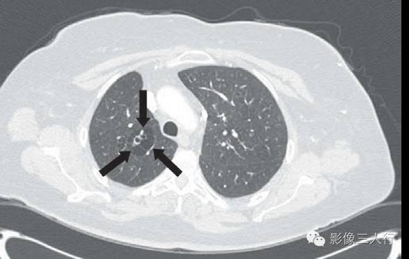 先天性囊性腺瘤样畸形