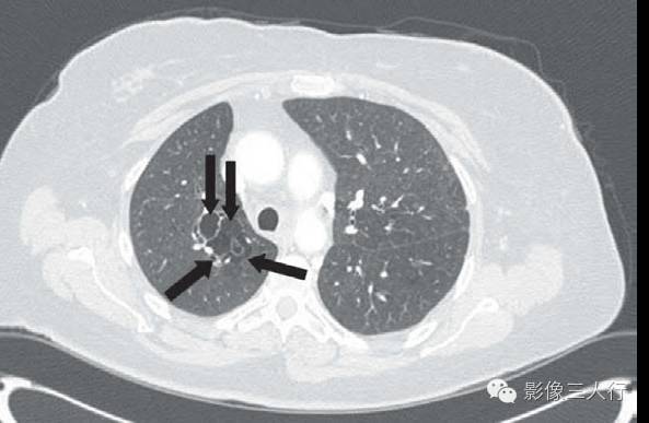 先天性囊性腺瘤样畸形