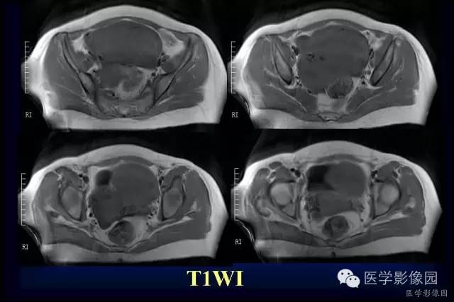 【病例】盆腔孤立性良性纤维瘤1例CT及MR影像表现