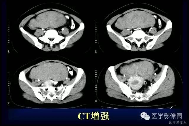 【病例】盆腔孤立性良性纤维瘤1例CT及MR影像表现