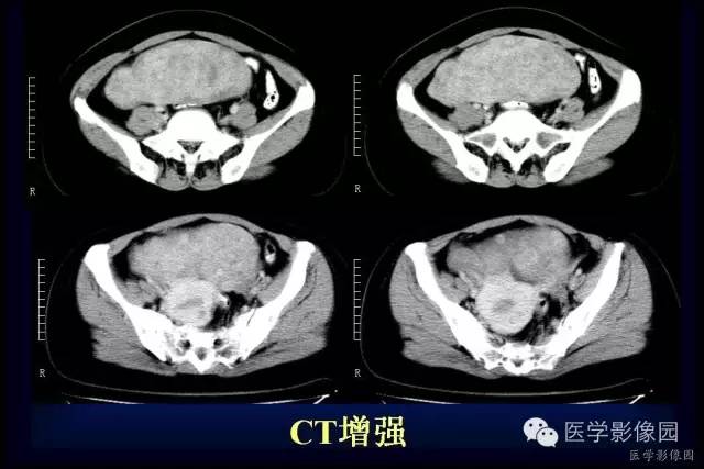 【病例】盆腔孤立性良性纤维瘤1例CT及MR影像表现