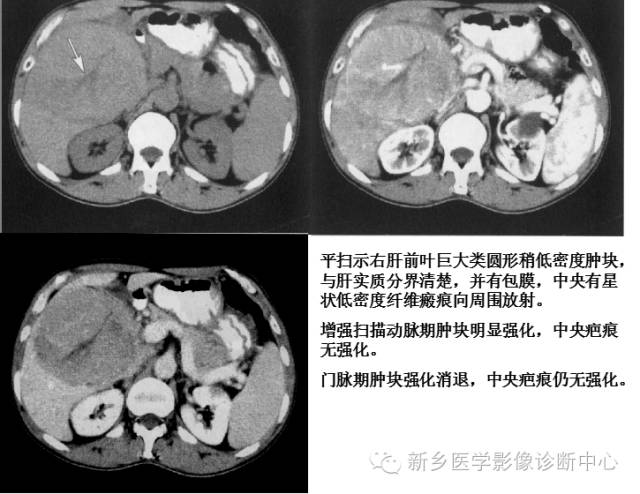 16种肝脏富血供病变 16种肝脏富血供病变