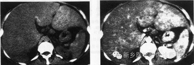 16种肝脏富血供病变 16种肝脏富血供病变