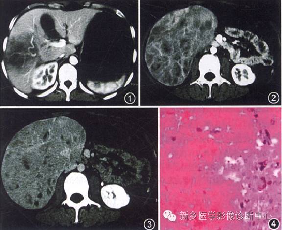 16种肝脏富血供病变 16种肝脏富血供病变