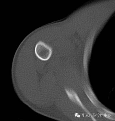 【病例】肱骨嗜酸性肉芽肿1例影像表现