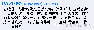 【病例】肱骨嗜酸性肉芽肿1例影像表现