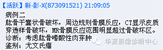 【病例】肱骨嗜酸性肉芽肿1例影像表现