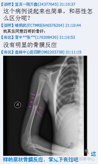 【病例】肱骨嗜酸性肉芽肿1例影像表现