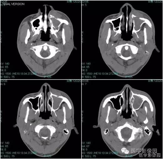 【病例】鼻硬结病1例CT影像表现