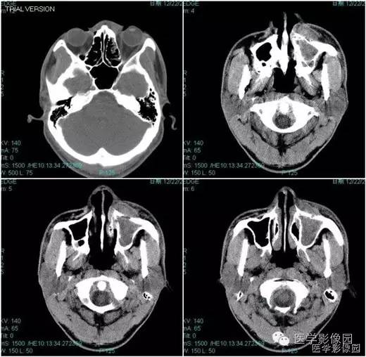 【病例】鼻硬结病1例CT影像表现 【病例】鼻硬结病1例CT影像表现