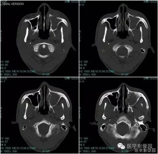 【病例】鼻硬结病1例CT影像表现 【病例】鼻硬结病1例CT影像表现