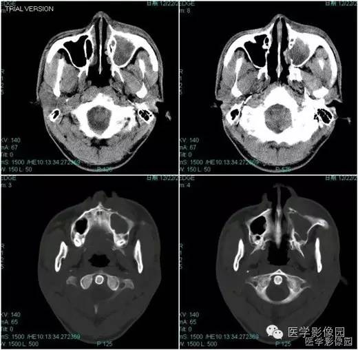 【病例】鼻硬结病1例CT影像表现 【病例】鼻硬结病1例CT影像表现