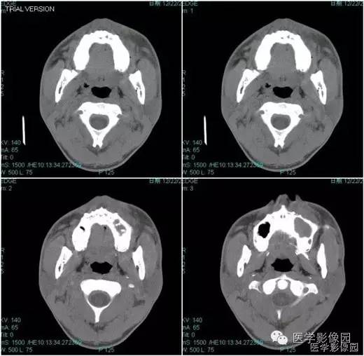 【病例】鼻硬结病1例CT影像表现 【病例】鼻硬结病1例CT影像表现