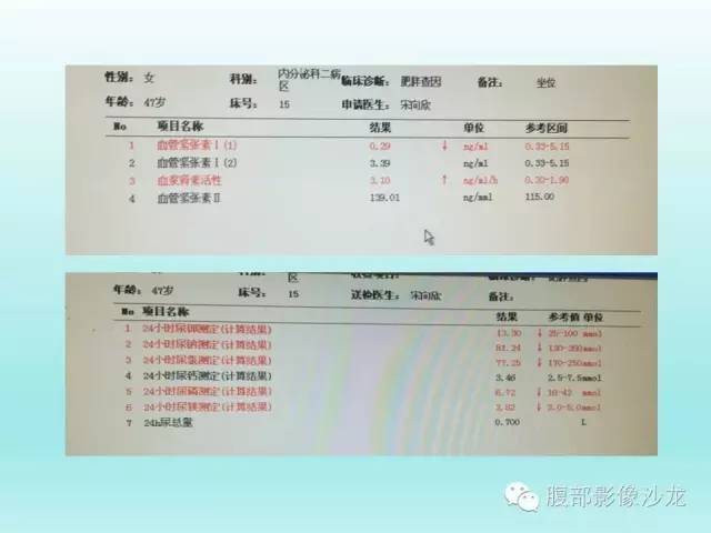 【病例】肾上腺髓样脂肪瘤1例CT影像表现 【病例】肾上腺髓样脂肪瘤1例CT影像表现