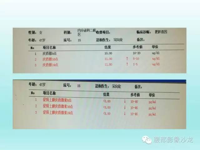 【病例】肾上腺髓样脂肪瘤1例CT影像表现 【病例】肾上腺髓样脂肪瘤1例CT影像表现