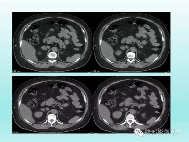 【病例】肾上腺髓样脂肪瘤1例CT影像表现 【病例】肾上腺髓样脂肪瘤1例CT影像表现