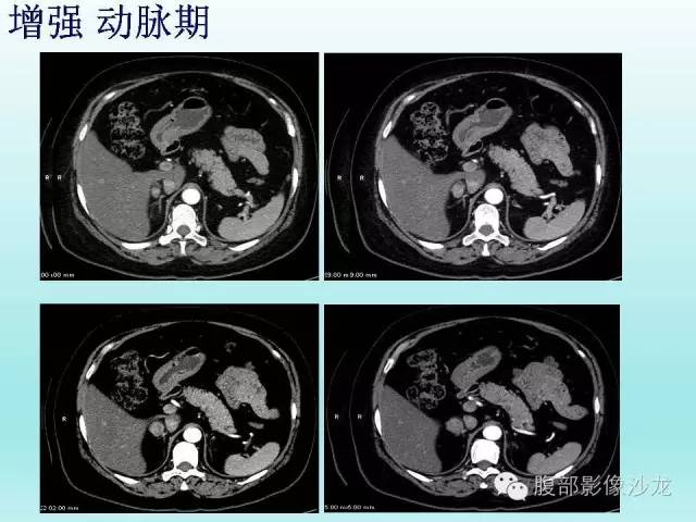【病例】肾上腺髓样脂肪瘤1例CT影像表现 【病例】肾上腺髓样脂肪瘤1例CT影像表现
