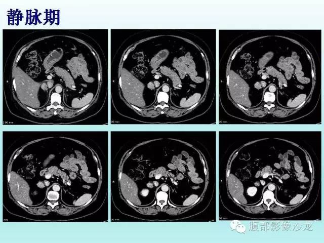 【病例】肾上腺髓样脂肪瘤1例CT影像表现 【病例】肾上腺髓样脂肪瘤1例CT影像表现