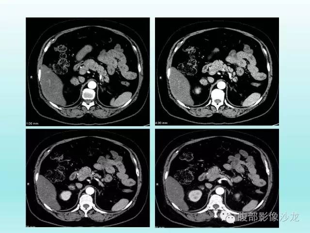 【病例】肾上腺髓样脂肪瘤1例CT影像表现 【病例】肾上腺髓样脂肪瘤1例CT影像表现