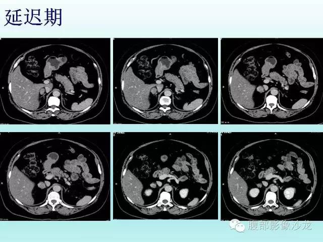 【病例】肾上腺髓样脂肪瘤1例CT影像表现 【病例】肾上腺髓样脂肪瘤1例CT影像表现