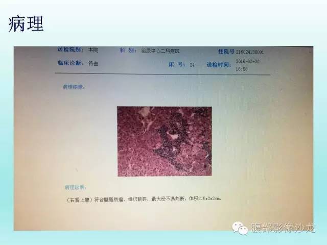 【病例】肾上腺髓样脂肪瘤1例CT影像表现 【病例】肾上腺髓样脂肪瘤1例CT影像表现