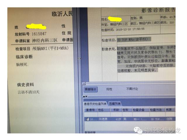 【病例】肝性脑病1例CT及MR影像表现