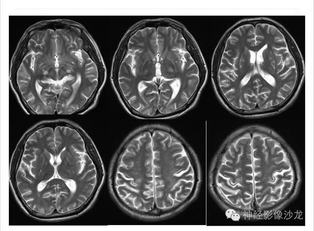 【病例】肝性脑病1例CT及MR影像表现