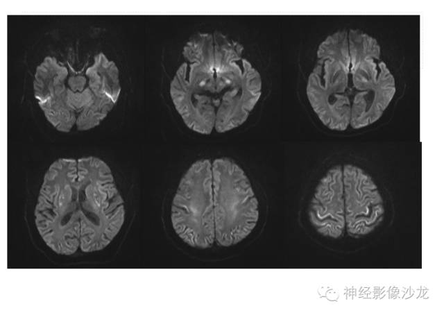 【病例】肝性脑病1例CT及MR影像表现