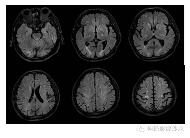 【病例】肝性脑病1例CT及MR影像表现