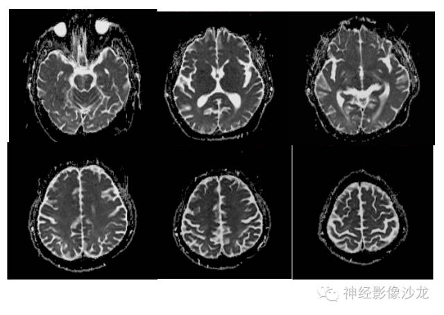 【病例】肝性脑病1例CT及MR影像表现
